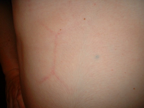 there used to be a six-pack there, i swear a mark on my abdomen shaped like a soccer ball's seam