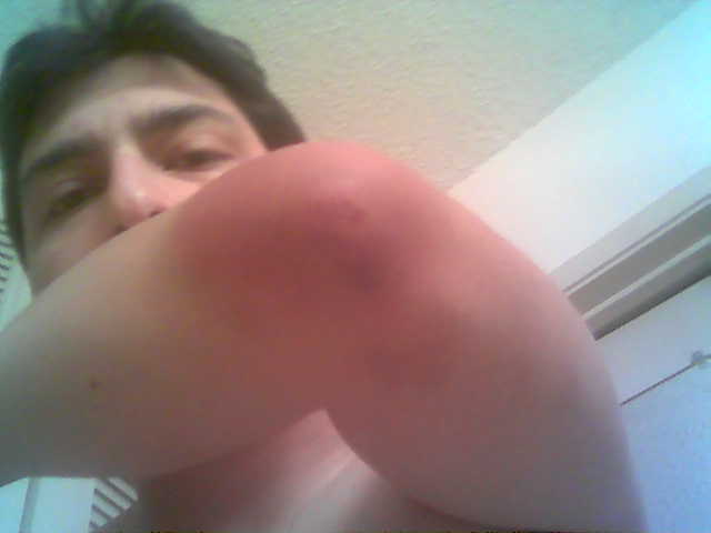 Elbow Bruise