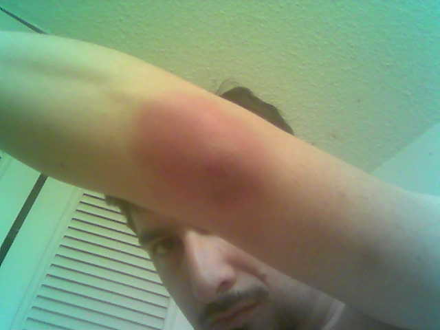 Elbow Bruise